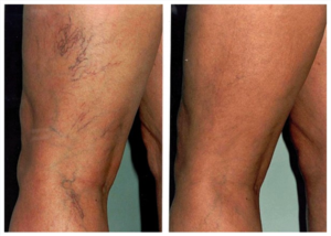 thread-vein-removal-legs