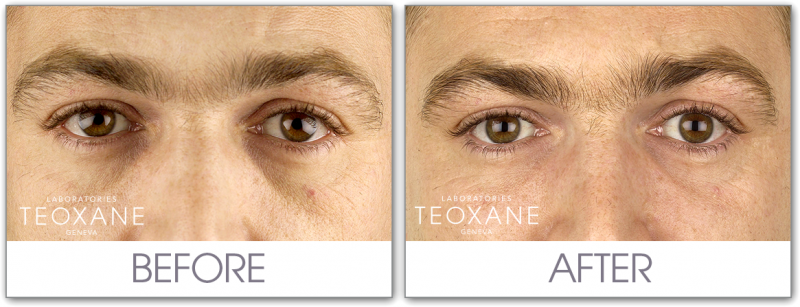 teoxane-before-after-eyes