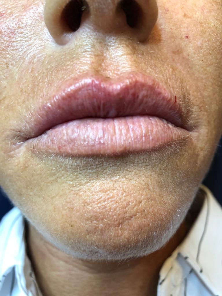 natalia-patient-lips-after1