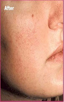 Thread Vein Removal - Face After