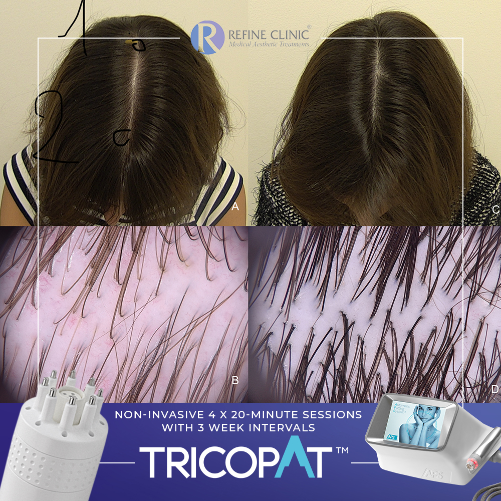 Tricopat-Before-And-After