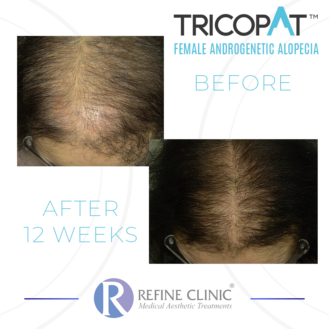 Tricopat-Before-And-After-4